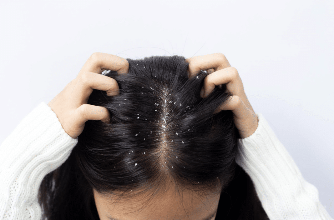 How to Get Rid of Dandruff: Your Ultimate Guide to Conquering Dandruff