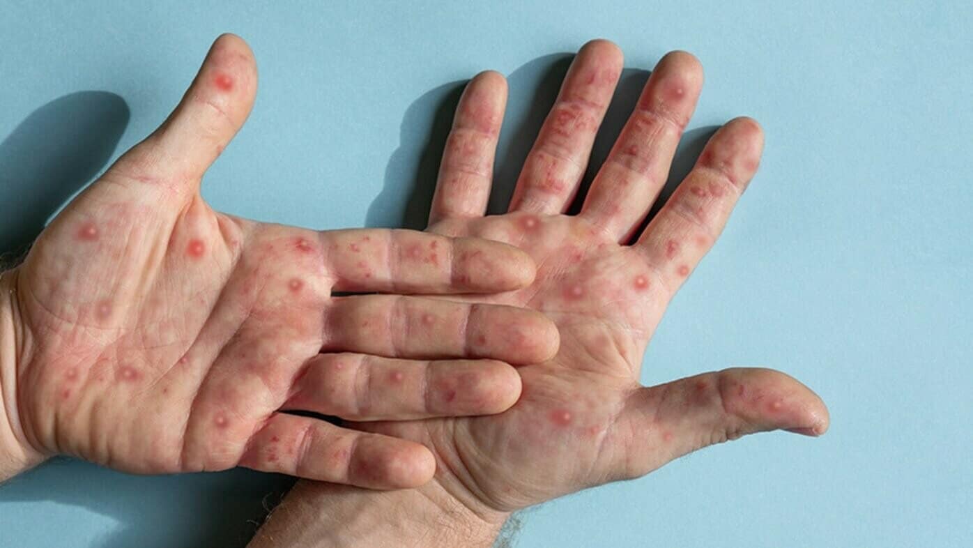 What is Monkeypox: Causes, Symptoms, and Treatment